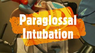 Vie Scope® Paraglossal Intubation (Off-Molar Intubation)