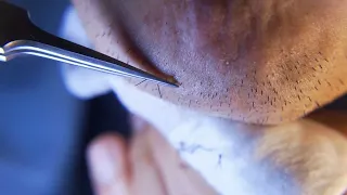 Hair removal asmr pull out with Tweezers  Satisfying pull out beard 10min 202404-1