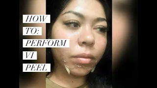How to: Perform a VI PEEL step by step (in depth tutorial)