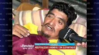 Familia de hombre con elefantiasis clama por ayuda para los gastos médicos