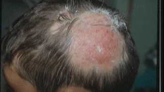 Micosis superficiales (hongos) en la piel, abordaje según la clínica y terapéutica adecuada
