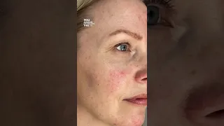 ROSACEA skin care TREATMENT ‼