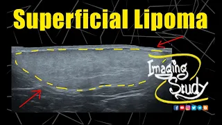 Superficial Lipoma || Ultrasound || Case 325