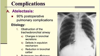 Post operative Pulmonary complications | General Surgery