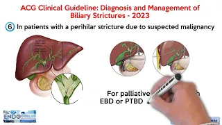ACG Clinical Guideline 2023: Diagnosis and Management of Biliary Strictures