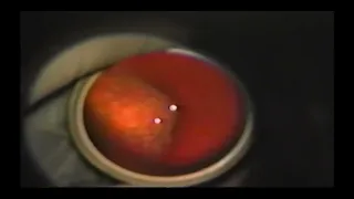 Retinal detachment: Encircling laser retinopexy technique - Supplementary video 1 [ID 406337]