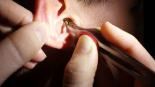 Removing impacted ear wax