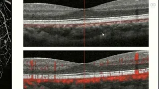 OCT Angiography: Revolutionizing Vitreoretinal Disease