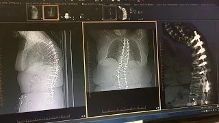 How much does spinal fusion limit mobility-- Not much