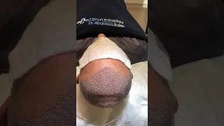 Hair Transplant | Elithair #shorts