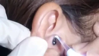Girl's Nasty Massive Earwax Removed with Ear Curette