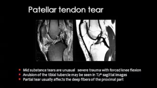 Imaging of the Knee joint  part III   DRE 3   Dr Mamdouh Mahfouz 720p