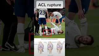 Rodrigo Bentancur ruptures ACL. Expert explains | #tottenham #thfc #tottenhamhotspur #epl #football