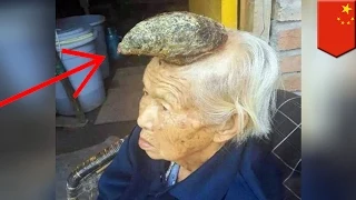 Chinese 'Unicorn woman' grows massive horn on her head and it keeps getting bigger - TomoNews