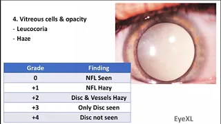 Intermediate Uveitis