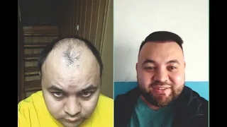 Hair Transplant result of a patient with large baldness - Video Review from the patient