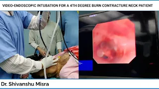 VIDEO-ENDOSCOPIC INTUBATION FOR A 4TH-DEGREE BURN CONTRACTURE NECK PATIENT