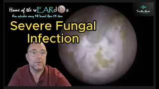 Severe Fungal Infection 188 #ear  #earwax #earwaxremoval #earcleaning #asmr #asmrearwax #satisfying