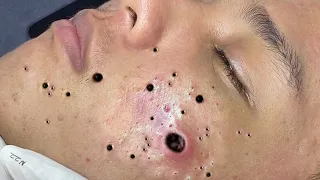 Extreme Blackhead Removal at LNG Skin Care #031