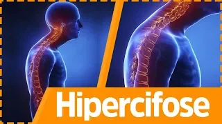 EXERCÍCIOS PARA HIPERCIFOSE DE MUSCULAÇÃO-  Fisioprev com Guilherme Stellbrink- 1 Parte