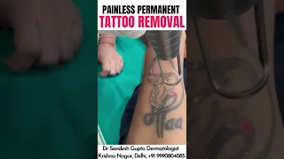 Permanent Tattoo Removal (Painless Treatment), By Dr. Sandesh Gupta #tattooremoval #shorts