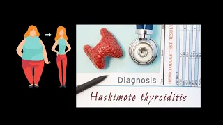 Schnell abnehmen mit Hashimoto oder Schilddrüsenunterfunktion. Ohne L-Thyroxin oder Diät!