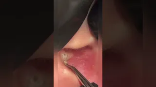 Ear pops