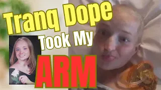 I lost my arm to Xylazine and Fentanyl - the story of Jess aka "one armd badass"