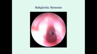 Subglottic Stenosis - CRASH! Medical Review Series