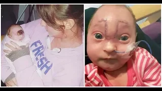 Baby Girl Born With Brain Outside Her Skull Is Declared A “Little Miracle”