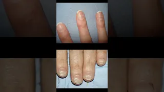 What your fingernails say about your health ! Part 2 •Beau's lines •Mees lines