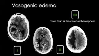 Imaging of Brain tumors   Prof Dr  Mamdouh Mahfouz In Arabic