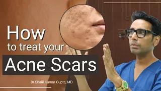 Acne Scars Treatment | Acne Scars Treatment by Dermatologist | Acne Scar Treatment before and after