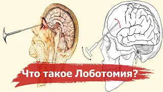 Лоботомия – кошмар 20 века | История самой ужасной операции