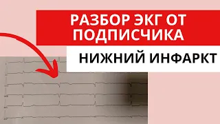 Разбор ЭКГ от подписчика. Нижний инфаркт? (Острый коронарный синдром с подъемом сегмента ST)