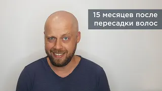 15 Месяцев ПОСЛЕ ПЕРЕСАДКИ ВОЛОС методом FUE