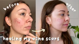 my 10-week microneedling results to fade my acne scars + discount code!