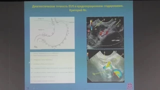 29 Павлов ПВ   Стадирование рака ЖКТ  Роль эндосонографии