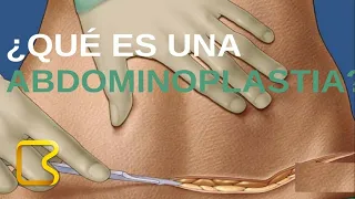 ¿Qué es una abdominoplastia?