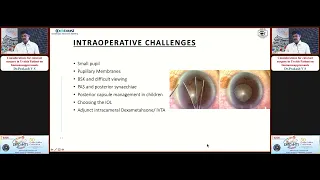 KSOS2023   IC29  Topic Dr Prakash V S  Considerations for cataract surgery in Uveitis Patient on Imm