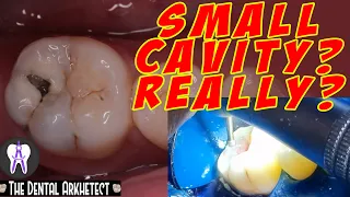 Molar Tooth Caries Removal and Restoration (Pasta sa Bagang)#42