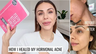 How I Healed My Hormonal Acne | Diet, Supplements & Skincare | Annie Jaffrey