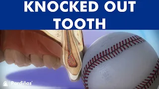 Knocked out tooth - What to do? - How to preserve it and replace it ©