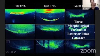 AIOS ARC PG Update Series  Evolving concepts to enhance a Cataract Surgeon   Dr  J  S  TITIYAL