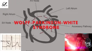 Preexcitation Syndromes: Wolff-Parkinson-White Syndrome