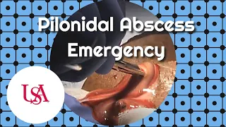 Pilonidal Abscess Emergency Incision & Drainage