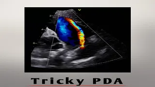 Tricky Patent ductus arteriosus (PDA)/ pediatric echo