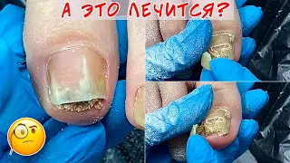 Онихогрифоз и грибок ногтей на ногах / Как помочь ногтю?