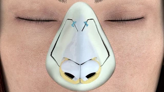 Piezotome® Rhinoplasty Protocol 3D