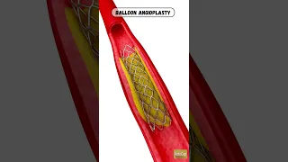 Balloon angioplasty | angioplasty | central vein balloon angioplasty | Angioplasty animation